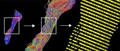 Detecting Corticospinal Tract Impairment in Tumor Patients With Fiber Density and Tensor-Based Metrics